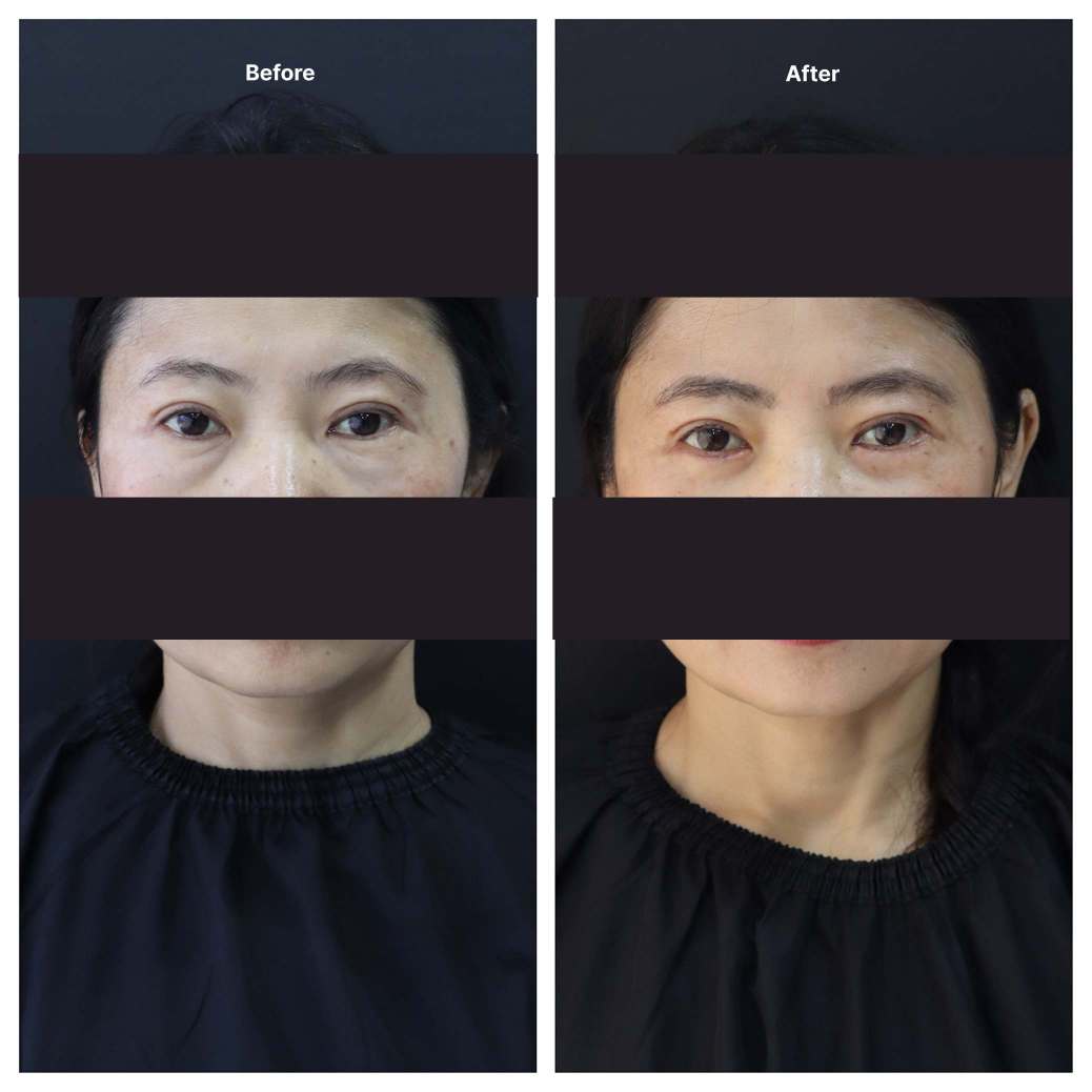 Eyelid Surgery KOQ10